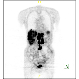 GA68 Dotatate PET/CT scan black and white view