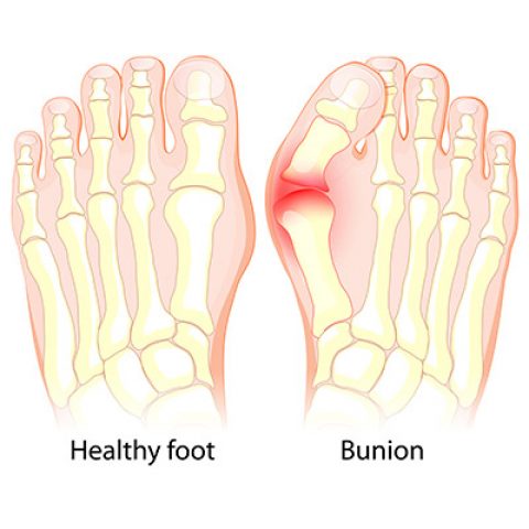 Bunions, a real pain in the toe